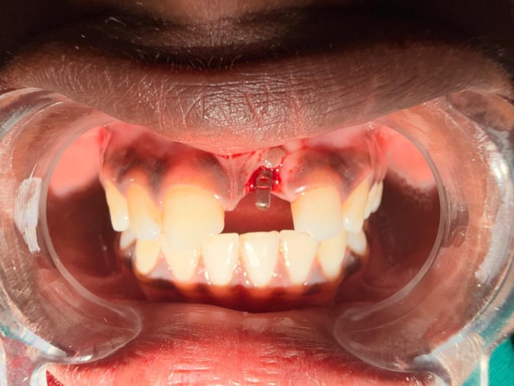 Dental Implants