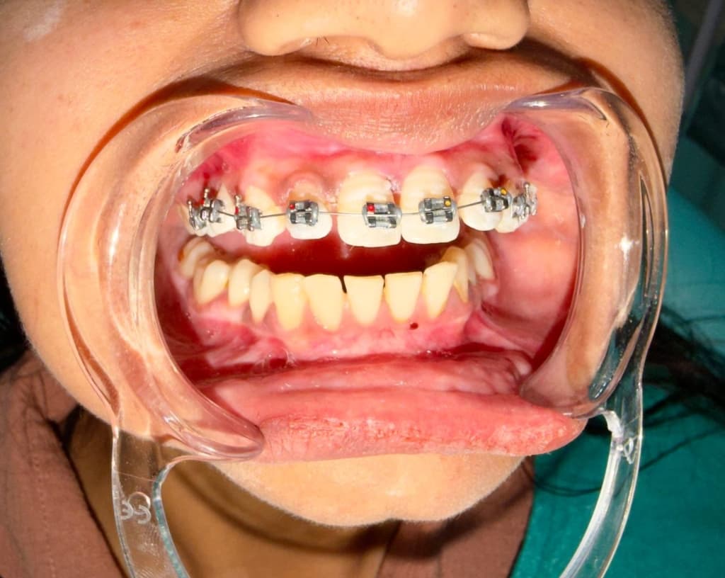 Orthodontic Treatment